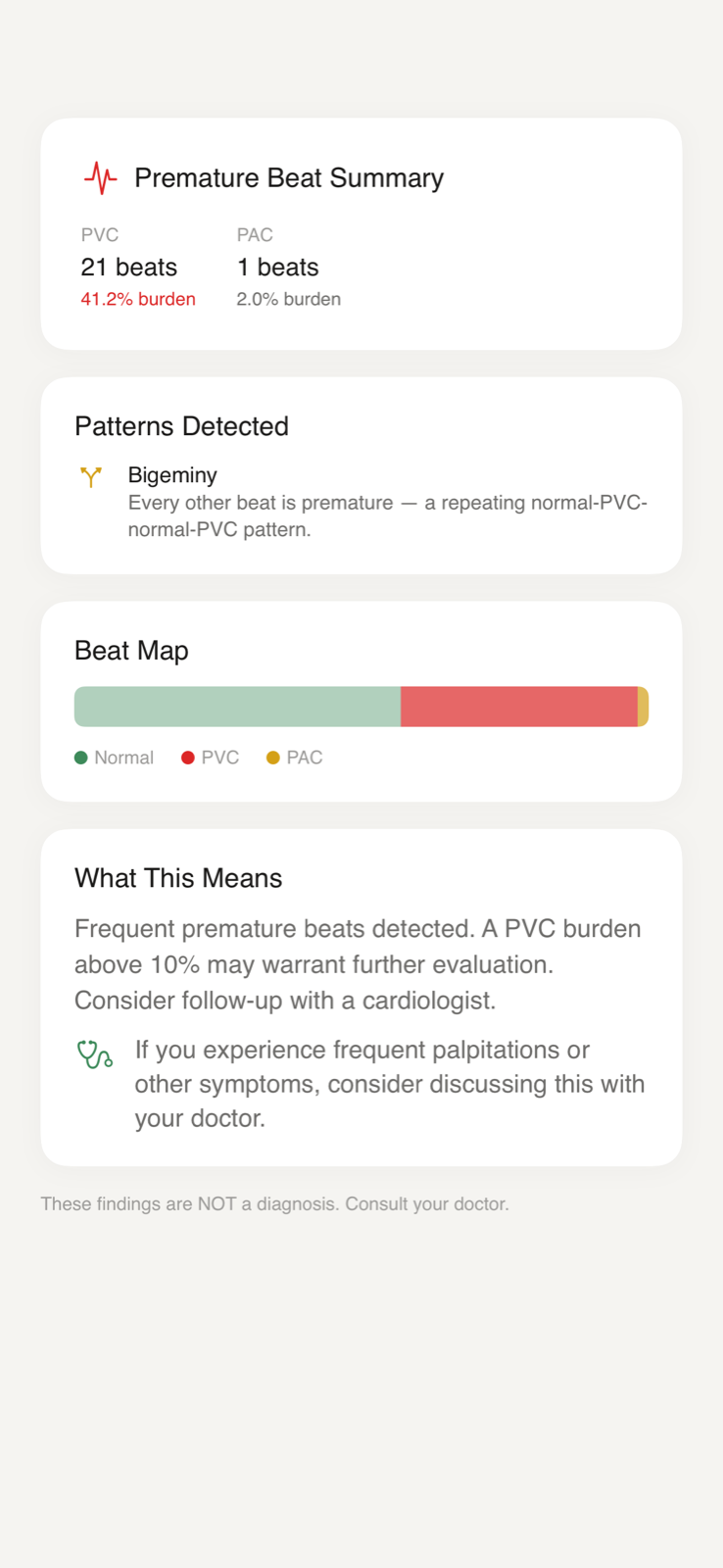 ECG strip with premature beats highlighted